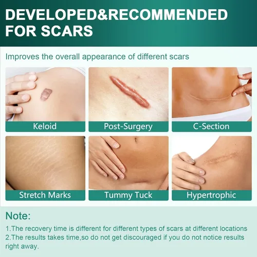 Vista 4 de Hojas de silicona para cicatrices, cinta de silicona para cicatrices (rollo de 1.6 x 120 pulgadas, rollo de 9.8 ft), hojas de eliminación